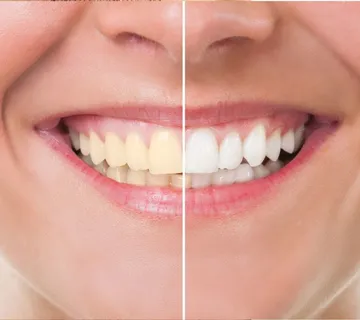 Izbjeljivanje zubi - cover