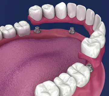 All-on-4 (four) zubni implantati - cover