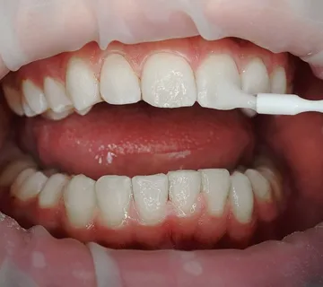 Remineralizacija zubi - cover