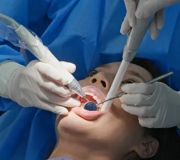 Apikotomija (operacija korijena zuba) - cover