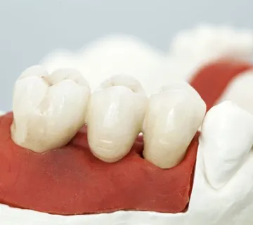 Zubni most (mostovi) - cover