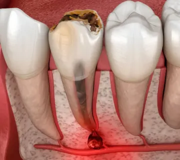 Cistektomija (operacija ciste na zubu) - cover