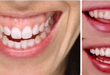 Gummy smile (korekcija osmijeha) - cover