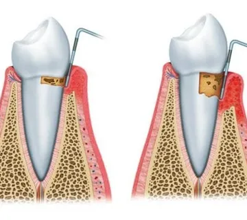Parodontitis - cover