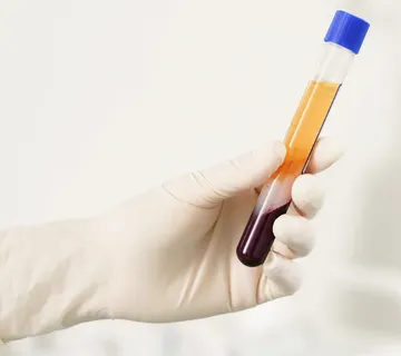 PRF - tretman plazmom - cover