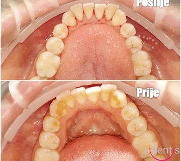 Profesionalno čišćenje zuba - cover