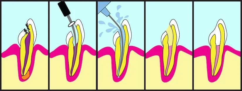 endodontsko liječenje (endodoncija) zuba - slika 3