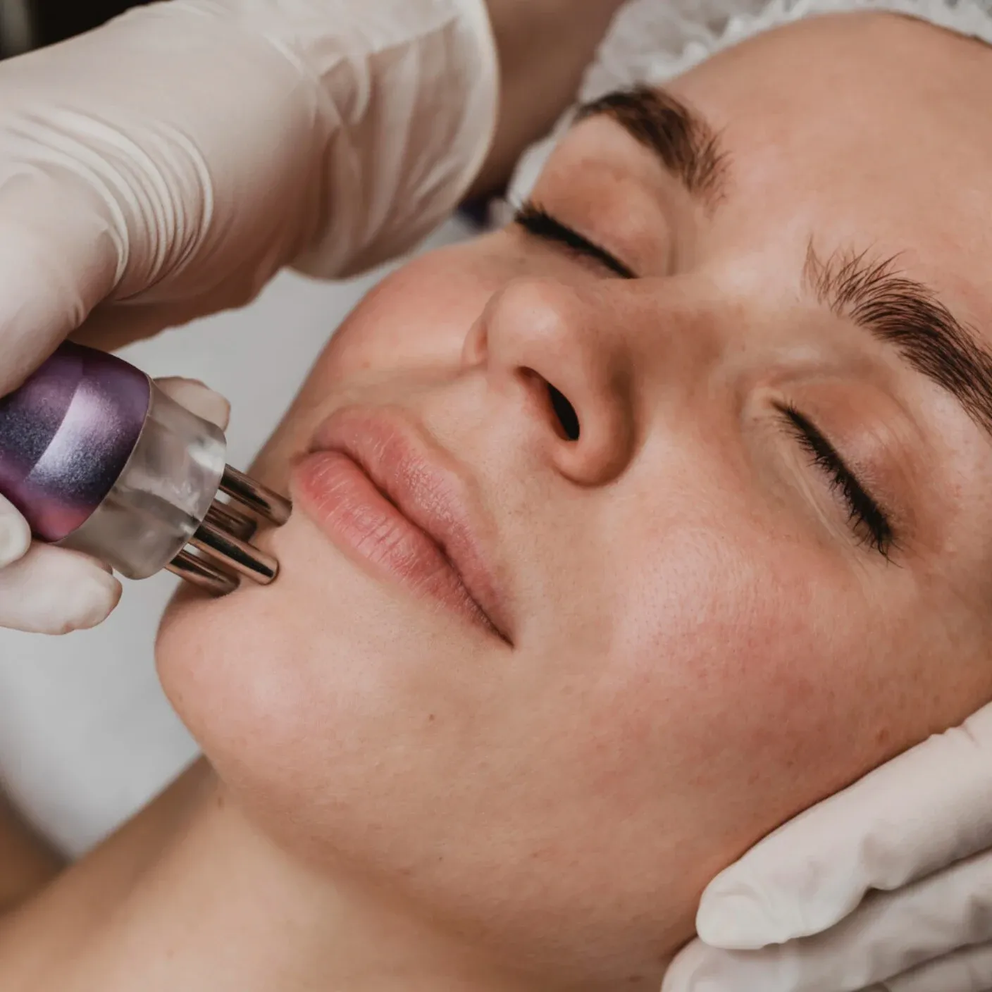 Microneedling - Zagreb