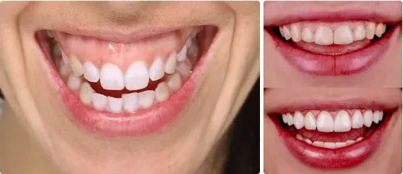 Gummy smile (korekcija osmijeha) - Zagreb