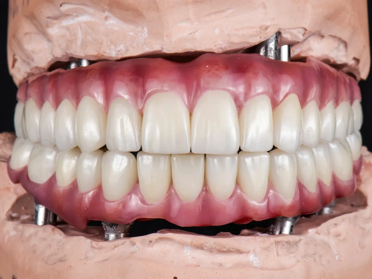 all-on-4 (four) zubni implantati - slika 2
