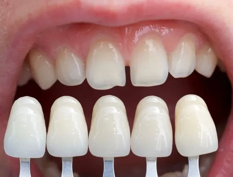 zubne ljuskice (veneers) - slika 3