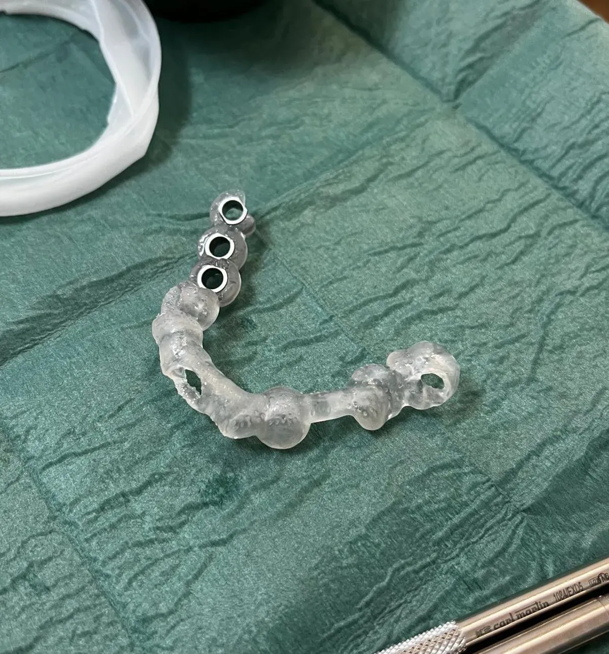 ugradnja zubnih implantata - slika 2