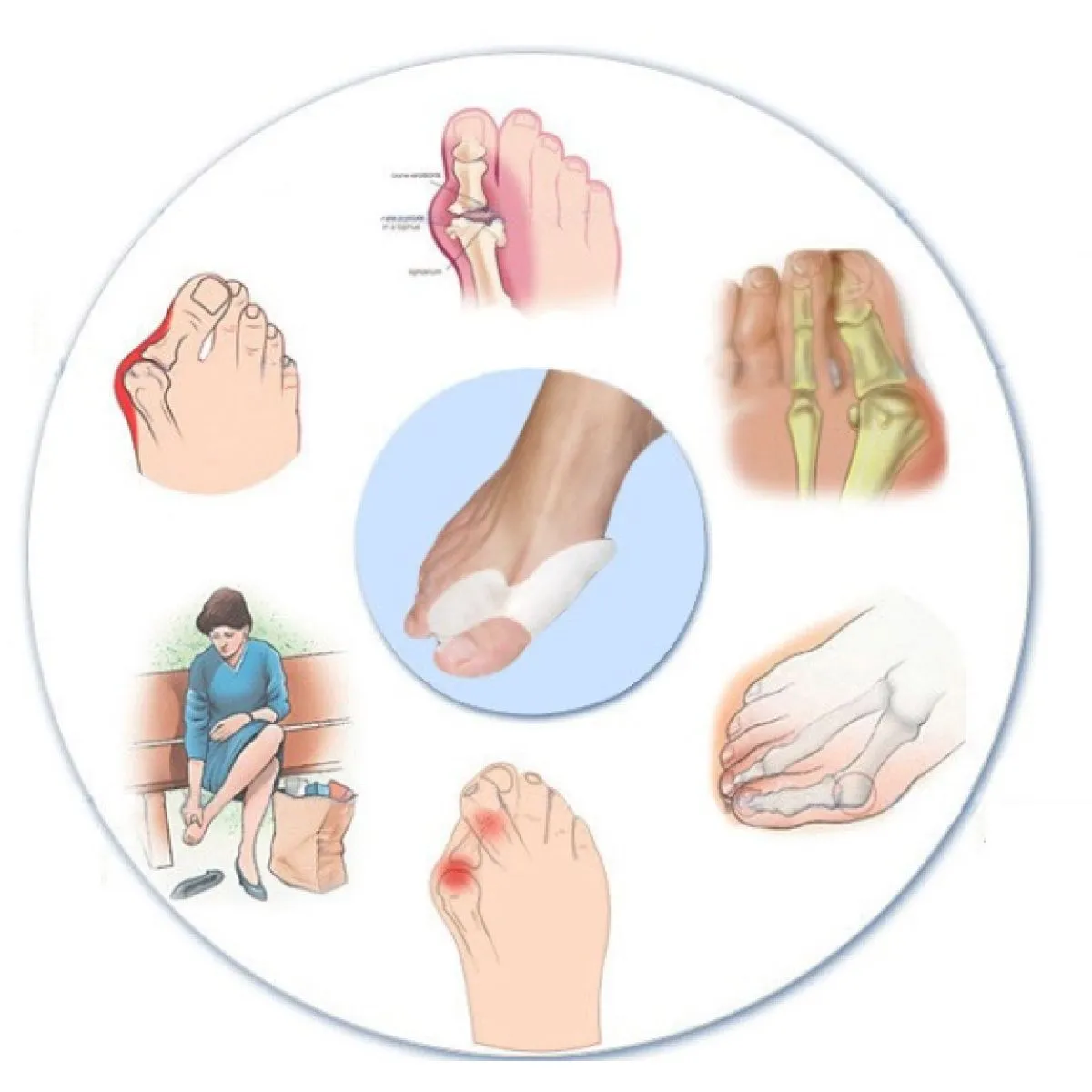 anatomski silikonski štitnici za deformirane nožne palce (čukljevi) - slika 3