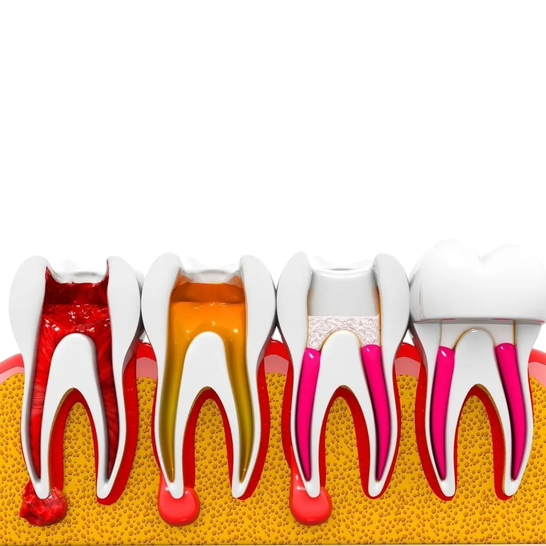 liječenje zuba – endodoncija - slika 3
