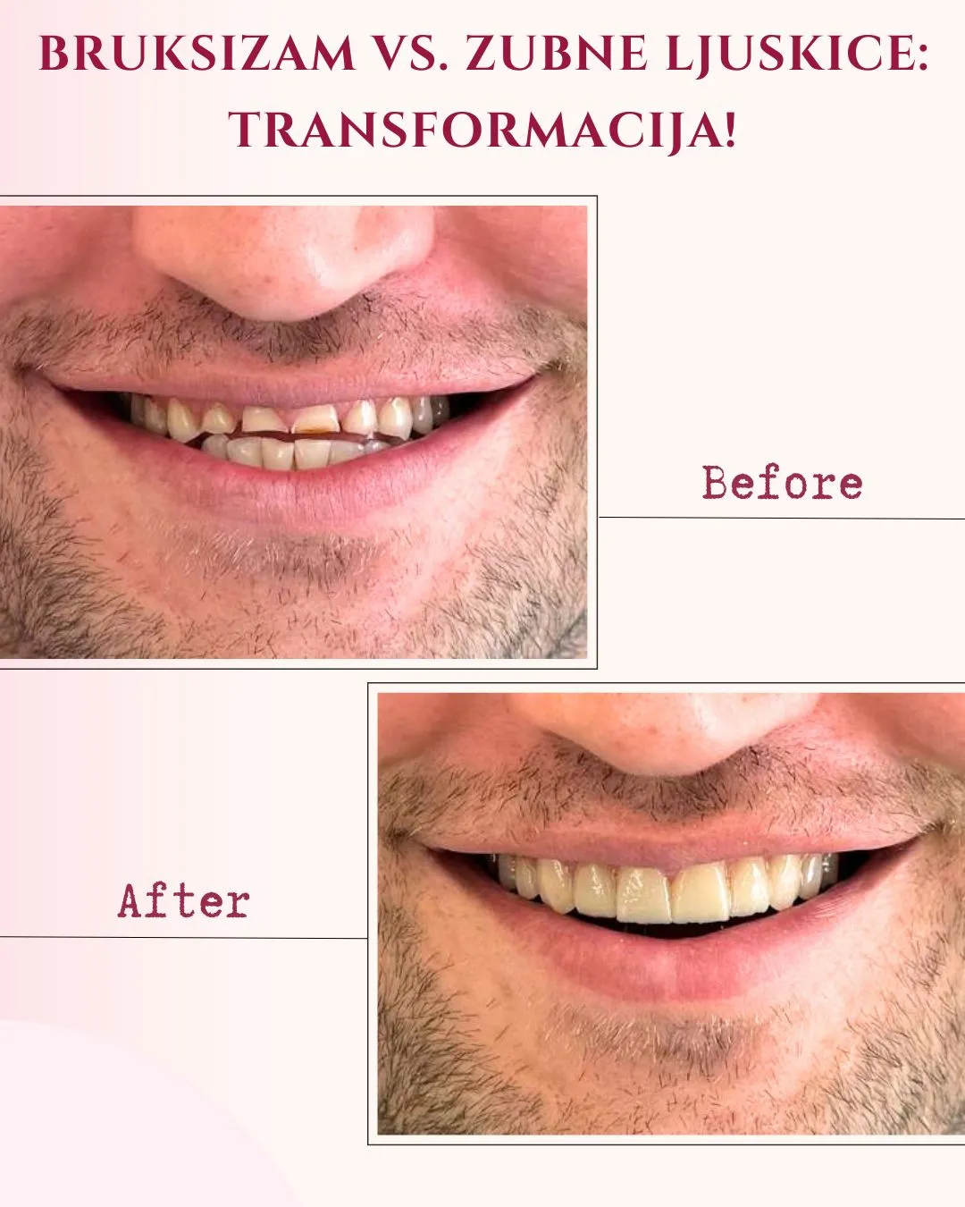 zubne ljuskice (veneers) - slika 2