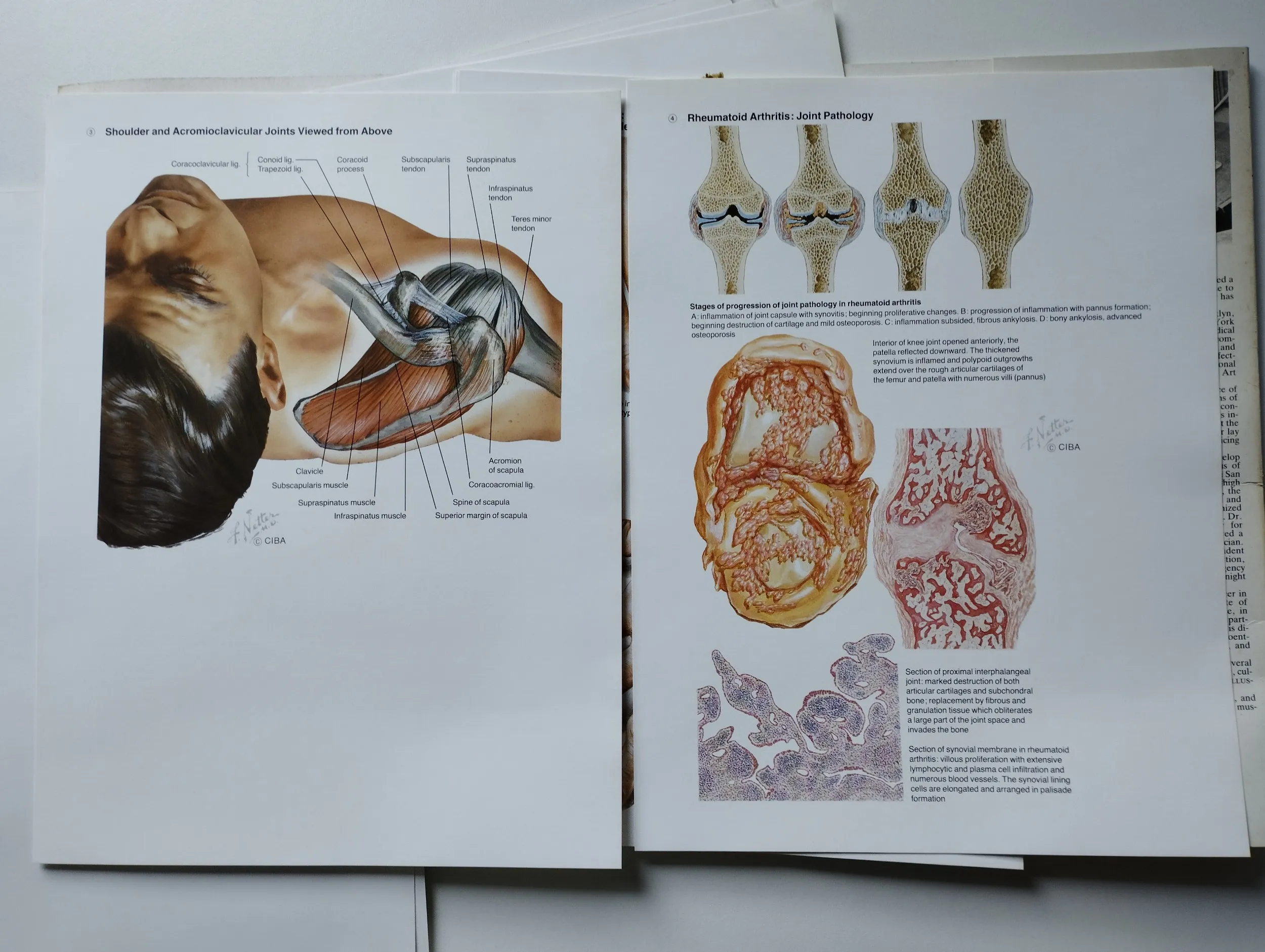 frank h netter, m.d. - netter art on rheumatic disorders - slika 7