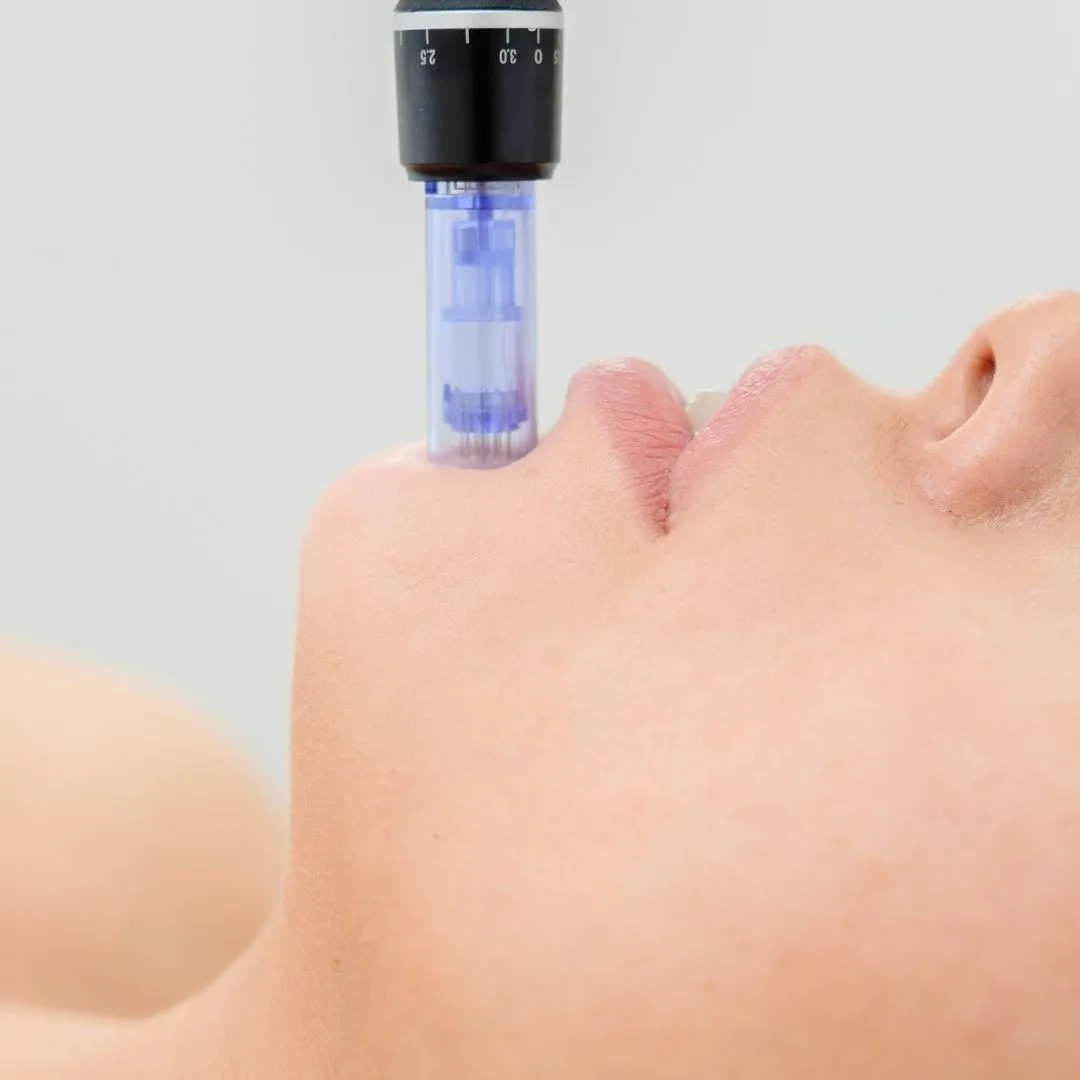 microneedling – skinpen - slika 1
