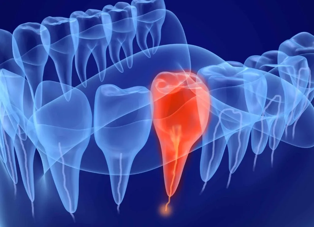 endodontsko liječenje (endodoncija) zuba - slika 2
