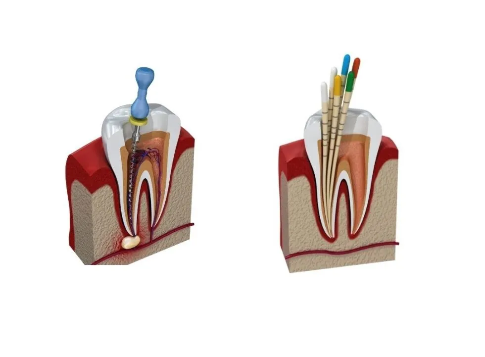 liječenje zuba – endodoncija - slika 5