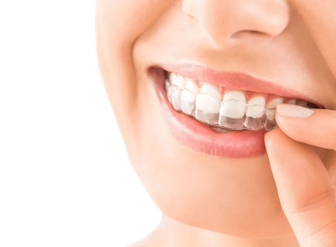 invisalign - slika 1