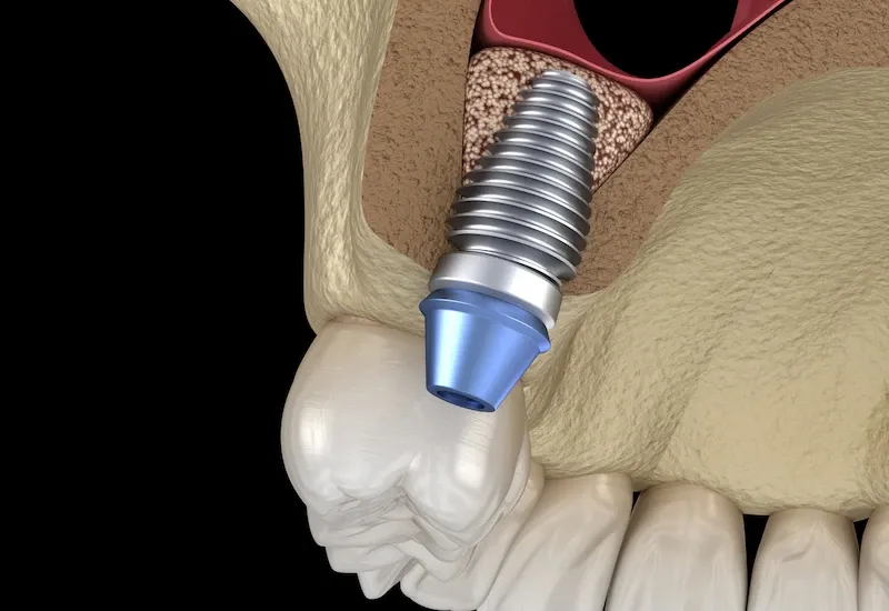 Sinus lift - Zagreb