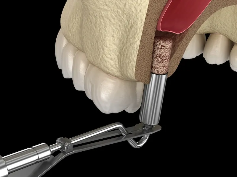 sinus lift - slika 2